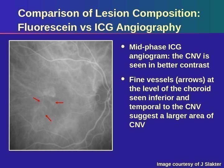 Comparison of Lesion Composition:  Fluorescein vs ICG Angiography Mid-phase ICG angiogram: the CNV