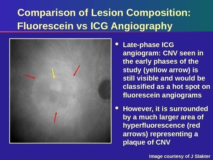 Comparison of Lesion Composition:  Fluorescein vs ICG Angiography Late-phase ICG angiogram: CNV seen