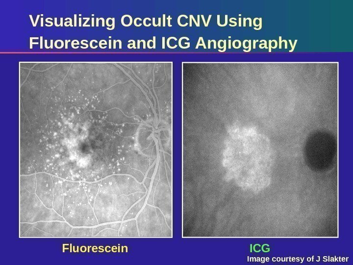Fluorescein ICGVisualizing Occult CNV Using Fluorescein and ICG Angiography Image courtesy of J Slakter