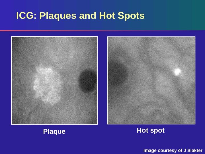 Hot spot Plaque. ICG: Plaques and Hot Spots Image courtesy of J Slakter 