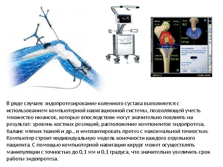 В ряде случаев эндопротезирование коленного сустава выполняется с использованием компьютерной навигационной системы, позволяющей учесть