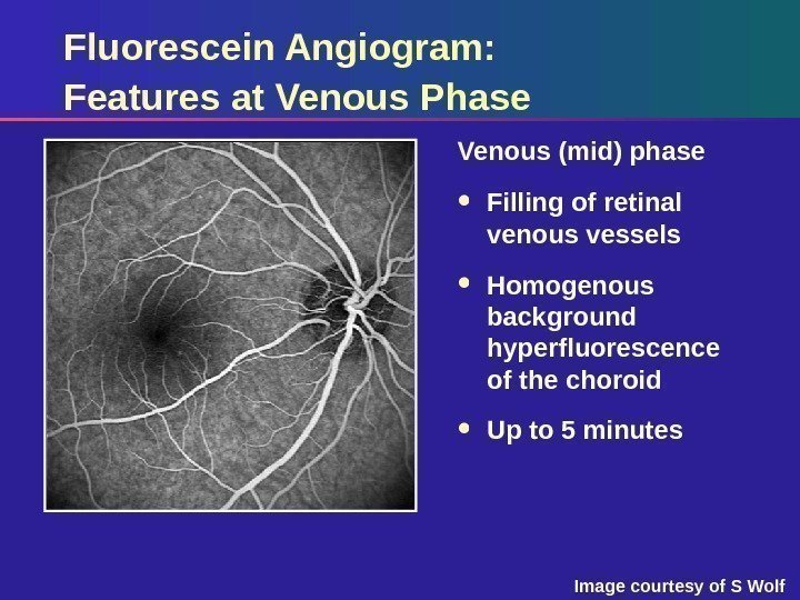 Fluorescein Angiogram:  Features at Venous Phase Venous (mid) phase Filling of retinal venous