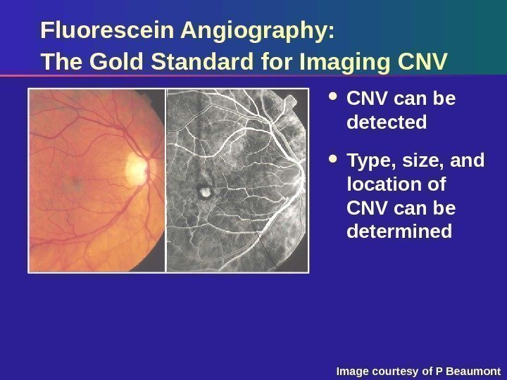 Fluorescein Angiography: The Gold Standard for Imaging CNV can be detected  Type, size,