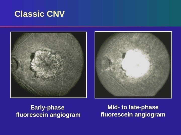 Classic CNV Early-phase fluorescein angiogram Mid- to late-phase fluorescein angiogram 