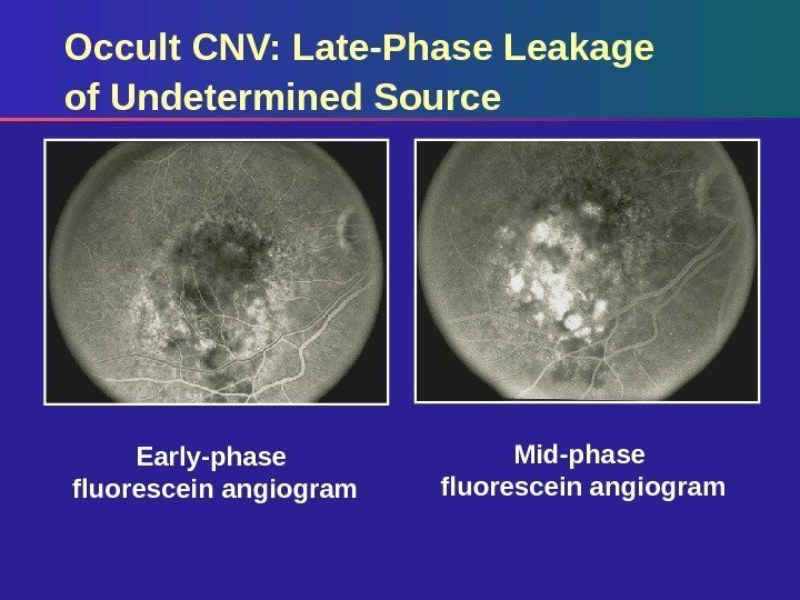 Early-phase fluorescein angiogram Mid-phase fluorescein angiogram. Occult CNV: Late-Phase Leakage of Undetermined Source 