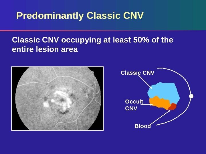 Predominantly Classic CNV occupying at least 50 of the entire lesion area Occult CNV