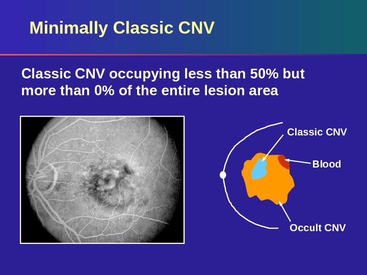 Minimally Classic CNV occupying less than 50 but more than 0 of the entire