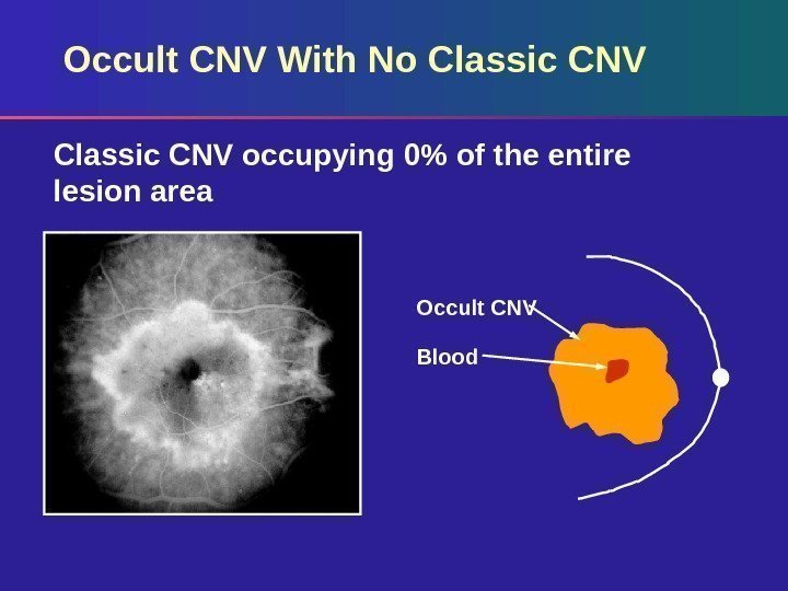Occult CNV With No Classic CNV occupying 0 of the entire lesion area Occult