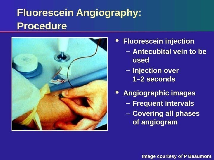 Fluorescein Angiography: Procedure Fluorescein injection – Antecubital vein to be used – Injection over