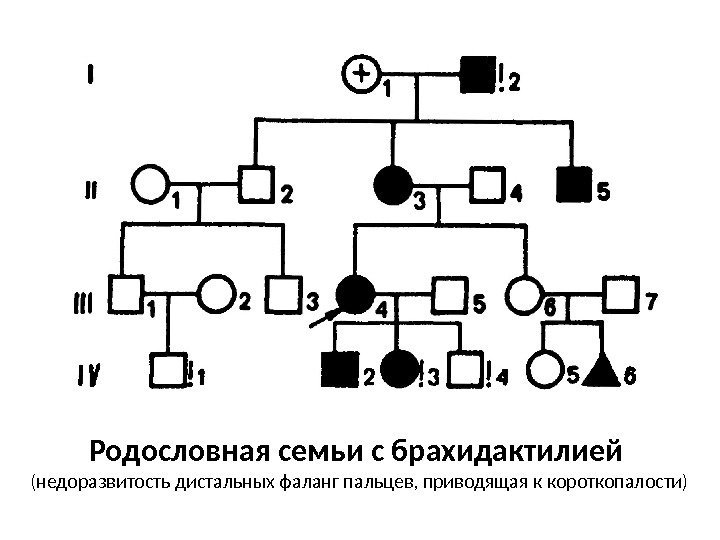 Родословная семьи с брахидактилией  (недоразвитость дистальных фаланг пальцев, приводящая к короткопалости) 