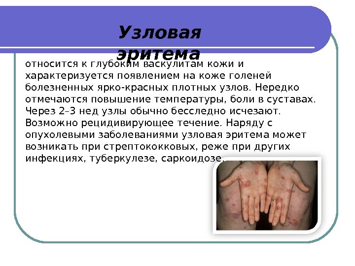 Узловая эритема относится к глубоким васкулитам кожи и характеризуется появлением на коже голеней болезненных