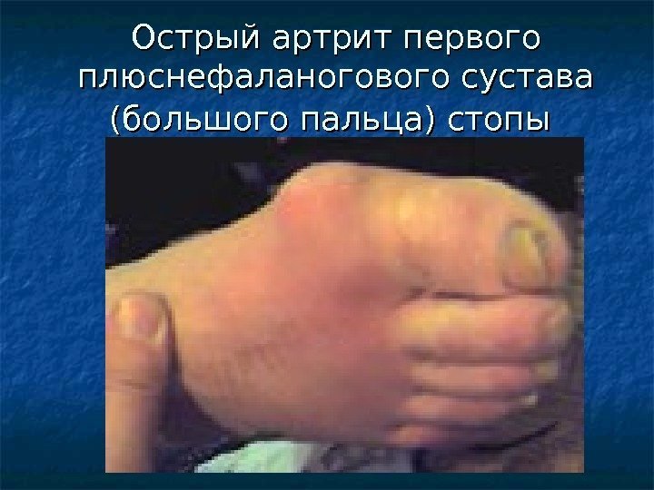 Острый артрит первого плюснефаланогового сустава (большого пальца) стопы  
