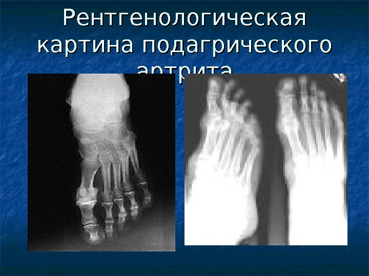 Рентгенологическая картина подагрического артрита 