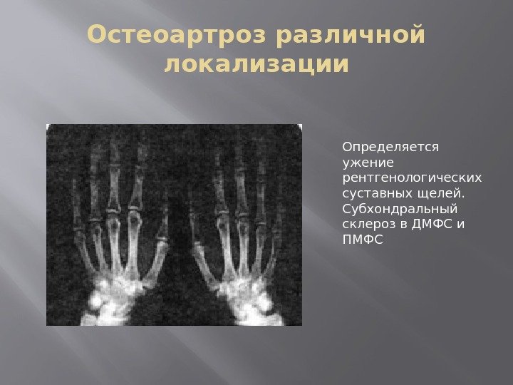 Остеоартроз различной локализации Определяется ужение рентгенологических суставных щелей.  Субхондральный склероз в ДМФС и