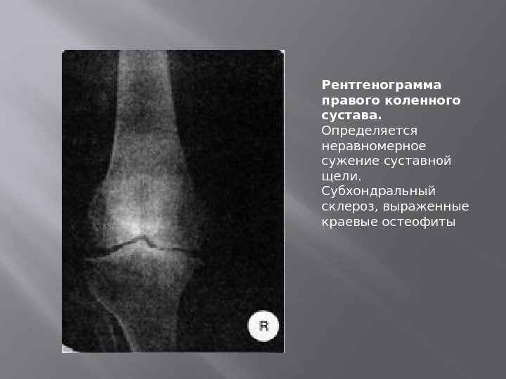 Рентгенограмма правого коленного сустава.  Определяется неравномерное сужение суставной щели.  Субхондральный склероз, выраженные