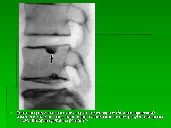  Рентгенограмма позвоночника при остеохондрозе (боковая проекция):  изменение замыкающих пластинок тел позвонков и