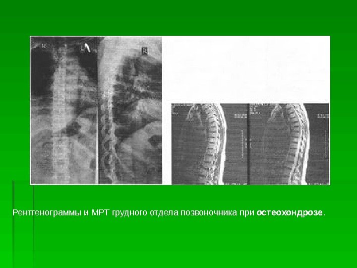 Рентгенограммы и МРТ грудного отдела позвоночника при остеохондрозе. 