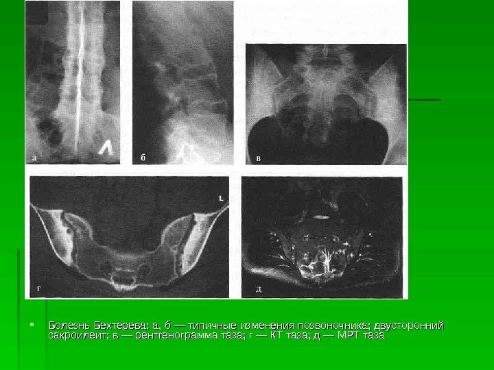  Болезнь Бехтерева: а, б — типичные изменения позвоночника; двусторонний сакроилеит; в — рентгенограмма