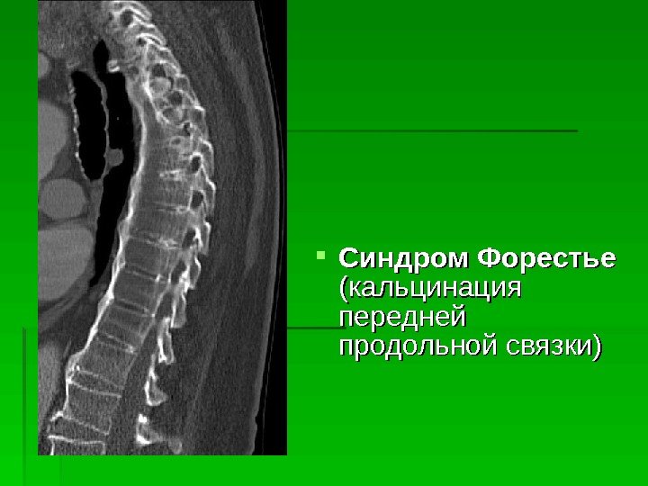  Синдром  Форестье  (кальцинация передней продольной связки)  