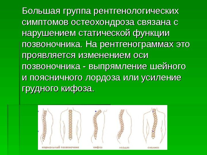   Большая группа рентгенологических симптомов остеохондроза связана с нарушением статической функции позвоночника. На