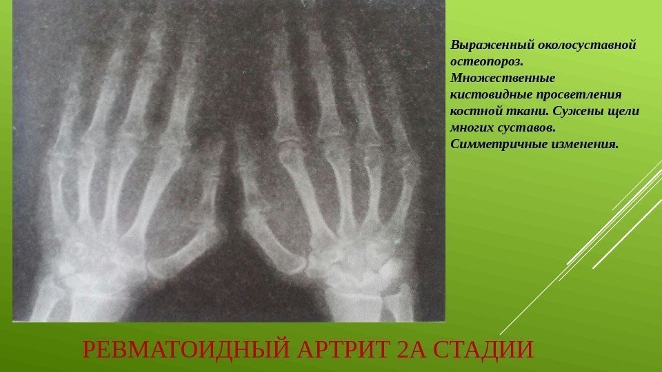 РЕВМАТОИДНЫЙ АРТРИТ 2 А СТАДИИ Выраженный околосуставной остеопороз.  Множественные кистовидные просветления костной ткани.