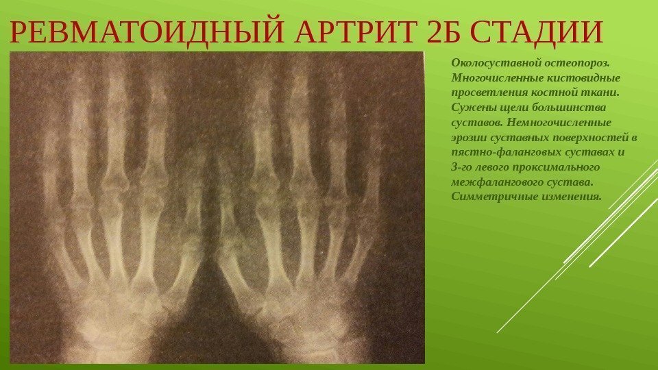 РЕВМАТОИДНЫЙ АРТРИТ 2 Б СТАДИИ Околосуставной остеопороз.  Многочисленные кистовидные просветления костной ткани. 