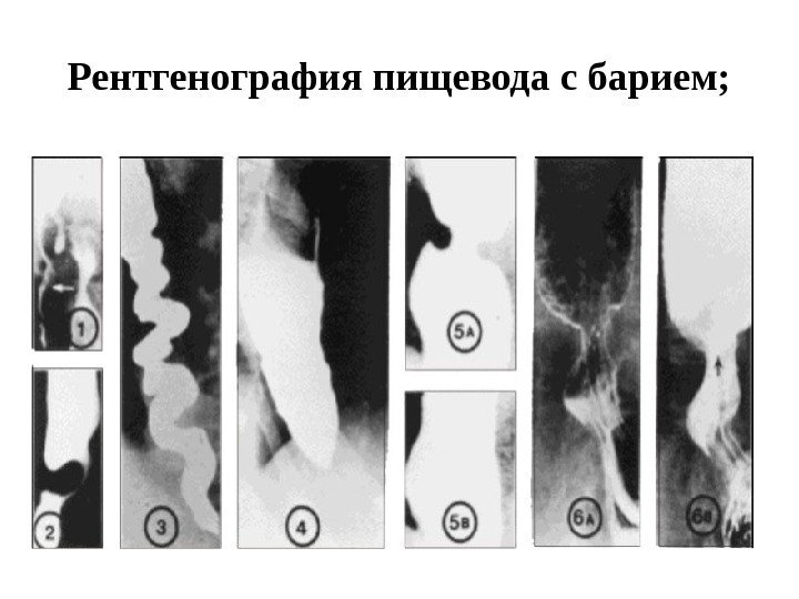 Рентгенография пищевода с барием; 