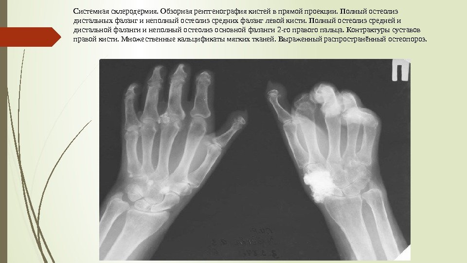 Early facial changes associated with scleroderma