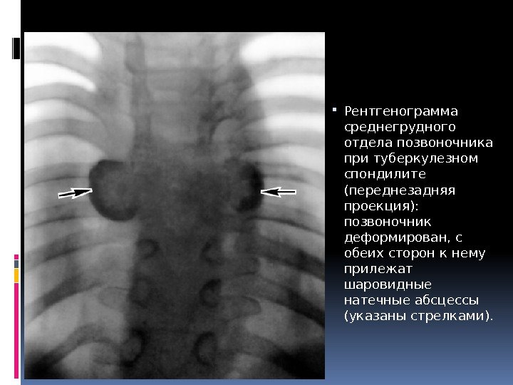  Рентгенограмма среднегрудного отдела позвоночника при туберкулезном спондилите (переднезадняя проекция):  позвоночник деформирован, с