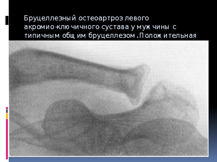 Бруцеллезны й остеоартроз левого акром ио-клю чичного сустава у м уж чины с типичны