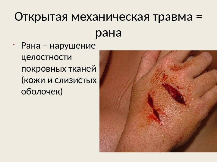 Открытая механическая травма = рана • Рана – нарушение целостности покровных тканей (кожи и