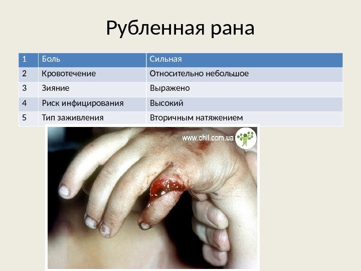 Рубленная рана 1 Боль Сильная 2 Кровотечение Относительно небольшое 3 Зияние Выражено 4 Риск