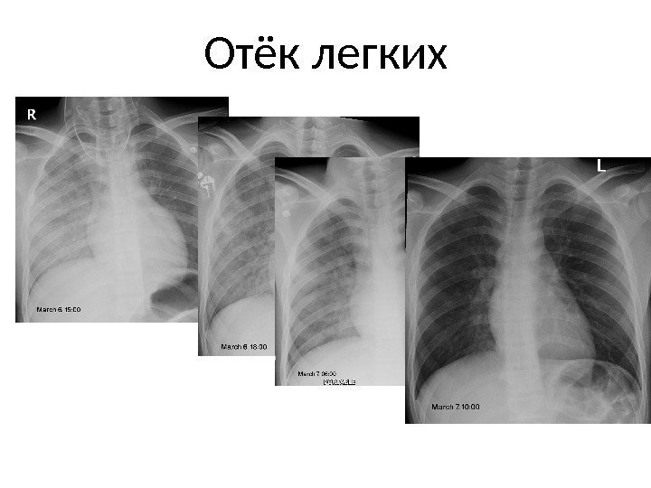 Edem pulmonar acut pe dreapta indus de laringospasm în evoluție  Отёк легких 