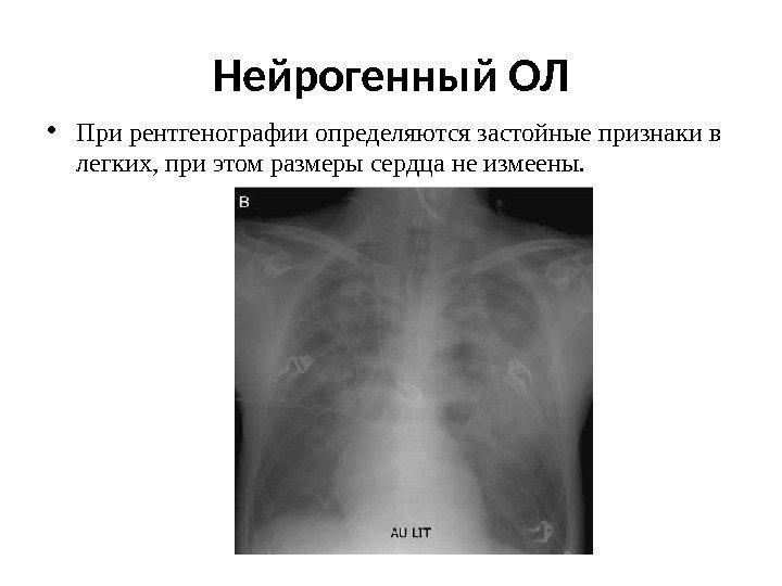 Нейрогенный ОЛ • При рентгенографии определяются застойные признаки в легких, при этом размеры сердца