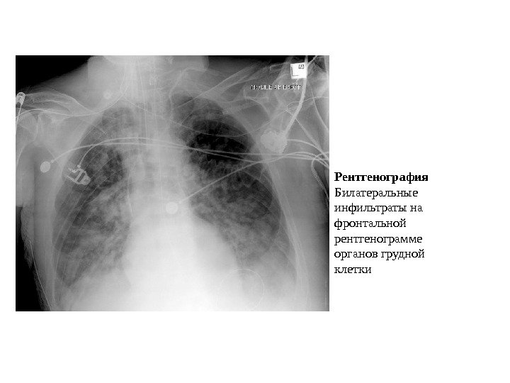 Рентгенография  Билатеральные инфильтраты на фронтальной рентгенограмме органов грудной клетки 