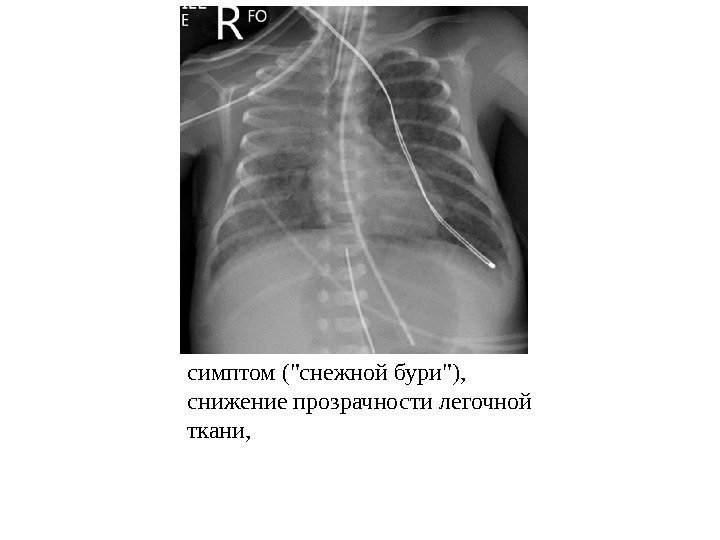 симптом (снежной бури),  снижение прозрачности легочной ткани, 