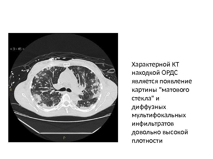 Характерной КТ находкой ОРДС является появление картины матового стекла и диффузных мультифокальных инфильтратов довольно