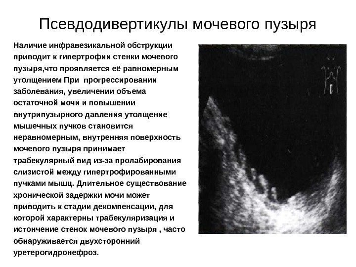 Псевдодивертикулы мочевого пузыря Наличие инфравезикальной обструкции приводит к гипертрофии стенки мочевого пузыря, что проявляется