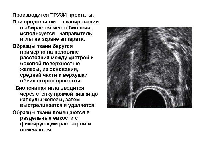 Производится ТРУЗИ простаты. При продольном сканировании выбирается место биопсии,  используется  направитель иглы