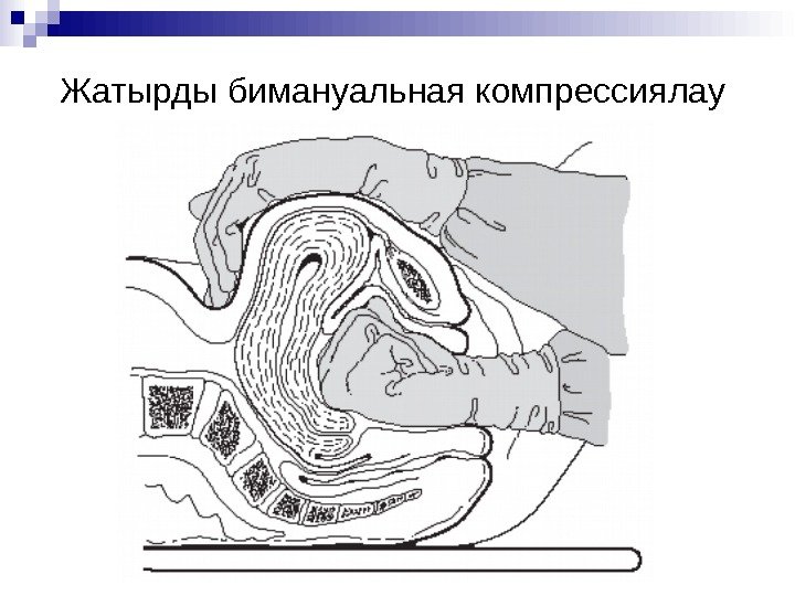 Жатырды бимануальная компрессиялау 