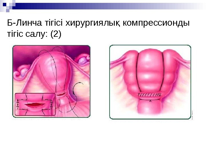 Б - Линча тігісі  хирургиялы кқ омпрессион ды тігіс салу :  (2)