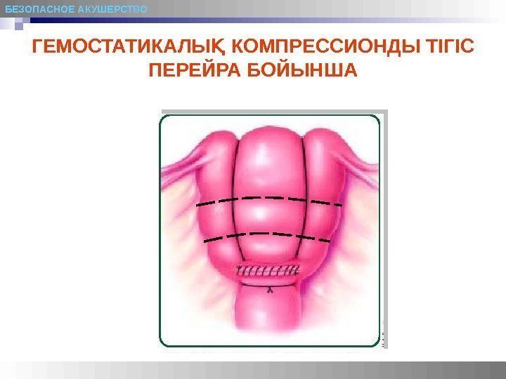 БЕЗОПАСНОЕ АКУШЕРСТВО ГЕМОСТАТИКАЛЫҚ  КОМПРЕССИОНДЫ ТІГІС  ПЕРЕЙРА БОЙЫНША 