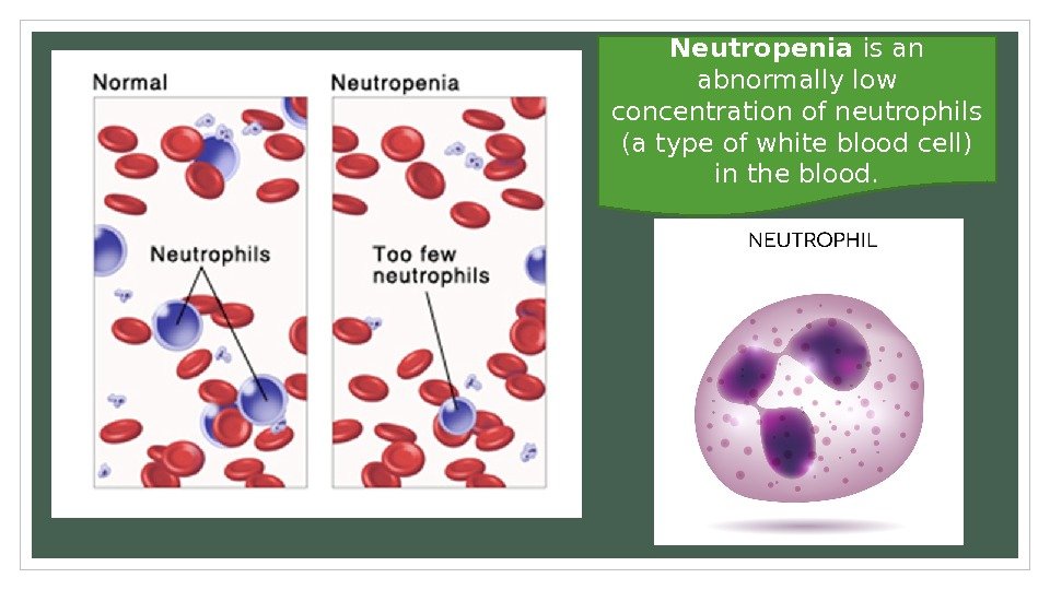 Neutropenia is an abnormally low concentration of neutrophils (a type of white blood cell)