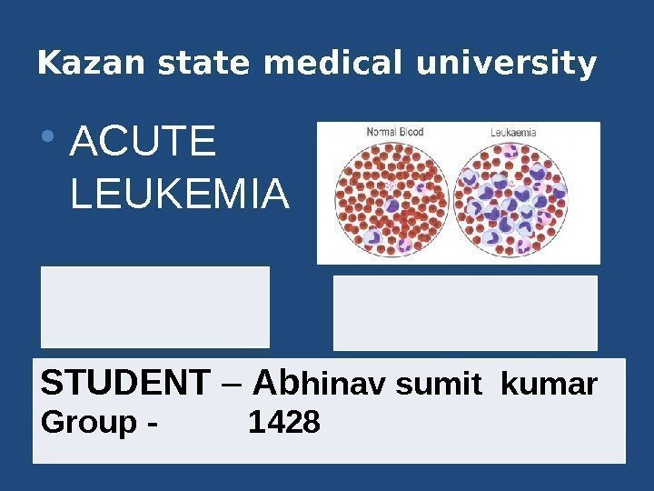 Kazan state medical university 1. Acute lymphocytic  leukemia ( ALL ) 2. Acute