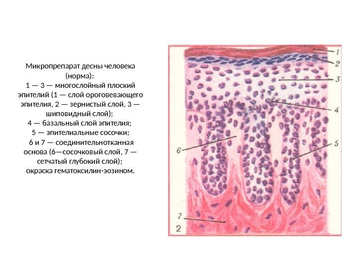Микропрепарат десны человека (норма):  1 — 3 — многослойный плоский эпителий (1 —