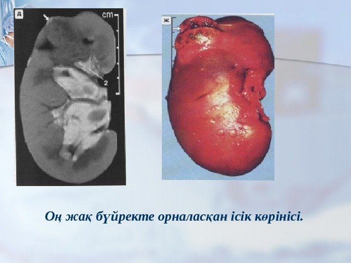 О жа б йректе орналас ан ісік к рінісі. ң қ ү қ ө