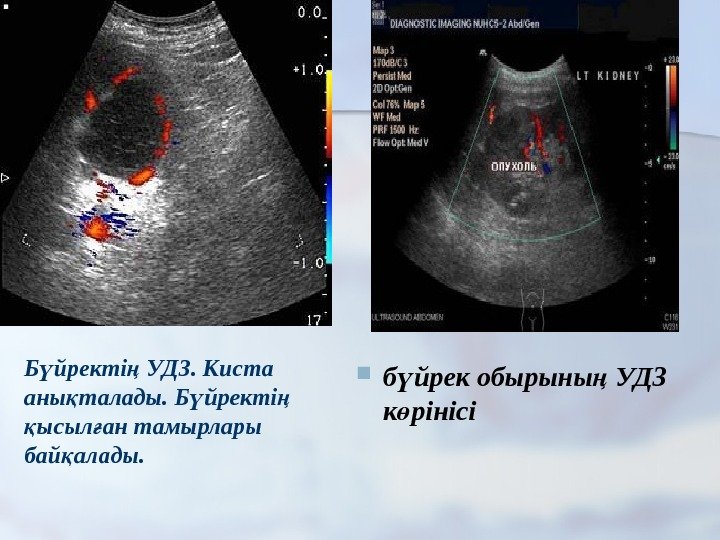  б йрек обырыны УДЗ ү ң к рінісі өБ йректі УДЗ. Киста ү