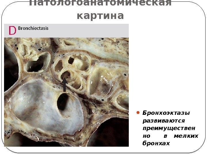 Патологоанатомическая  картина  Бронхоэктазы развиваются преимуществен но  в мелких бронхах 