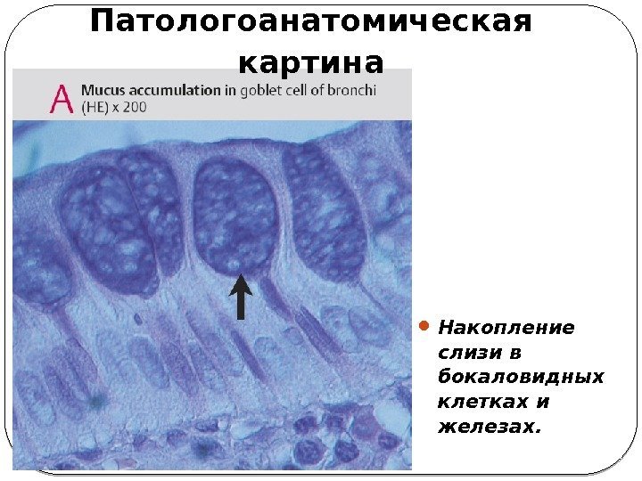  Накопление слизи в бокаловидных клетках и железах. Патологоанатомическая  картина  