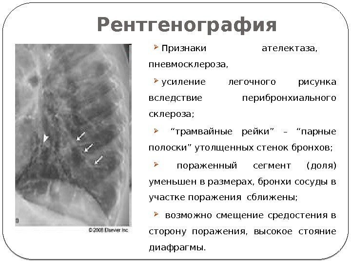 Рентгенография Признаки ателектаза, пневмосклероза,  усиление легочного рисунка вследствие перибронхиального склероза; “ трамвайные рейки”